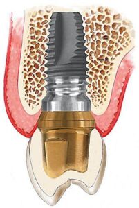 implant dentar3